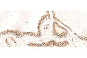 Immunohistochemistry of paraffin-embedded Human thyroid cancer tissue using RPL13A Polyclonal Antibody at dilution of 1:95(x200) (RPL13A 抗体)