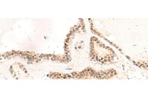 Immunohistochemistry of paraffin-embedded Human thyroid cancer tissue using RPL13A Polyclonal Antibody at dilution of 1:95(x200) (RPL13A 抗体)