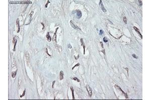 Immunohistochemical staining of paraffin-embedded Carcinoma of pancreas using anti-GATA4 (ABIN2452678) mouse monoclonal antibody. (GATA4 抗体  (AA 296-442))