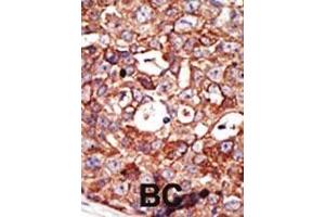 Formalin-fixed and paraffin-embedded human cancer tissue reacted with the primary antibody, which was peroxidase-conjugated to the secondary antibody, followed by DAB staining. (ZMPSTE24 抗体  (AA 400-430))