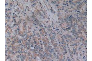 IHC-P analysis of Human Prostate Gland Cancer Tissue, with DAB staining. (NT5C3 抗体  (AA 52-336))