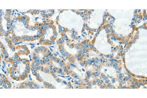 Immunohistochemistry of paraffin-embedded Human thyroid cancer tissue using L1CAM Polyclonal Antibody at dilution 1:40 (L1CAM 抗体)