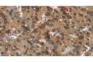 Immunohistochemistry of paraffin-embedded Human liver cancer tissue using DCC Polyclonal Antibody at dilution 1:70 (DCC 抗体)