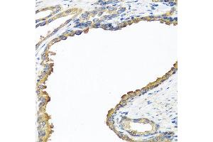 Immunohistochemistry of paraffin-embedded human prostate using NYX antibody at dilution of 1:100 (40x lens). (Nyctalopin 抗体)