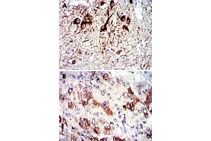 Immunohistochemical analysis of paraffin-embedded human medulla oblongata tissue (A) and liver cancer tissue (B) using TUBA8 monoclonal antobody, clone 2D6  with DAB staining. (TUBA8 抗体)
