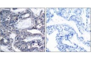 Immunohistochemistry analysis of paraffin-embedded human breast carcinoma, using MEK2 (Phospho-Thr394) Antibody. (MEK2 抗体  (AA 261-310))