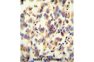 UGT3A2 antibody (C-term) immunohistochemistry analysis in formalin fixed and paraffin embedded human testis carcinoma followed by peroxidase conjugation of the secondary antibody and DAB staining.