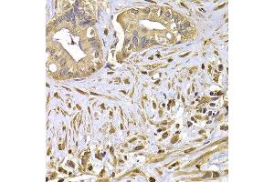 Immunohistochemistry of paraffin-embedded human liver cancer using FSCN1 antibody at dilution of 1:100 (x400 lens). (Fascin 抗体)