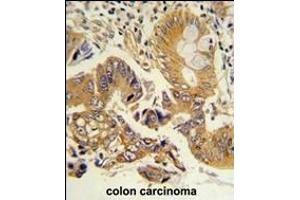 Formalin-fixed and paraffin-embedded human colon carcinoma reacted with CLNS1A Antibody (Center), which was peroxidase-conjugated to the secondary antibody, followed by DAB staining. (CLNS1A 抗体  (AA 148-176))