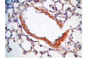 Mouse lung cancer tissue stained by Rabbit Anti-CRAMP (Mouse) Antibody (Cathelicidin 抗体  (AA 140-173))