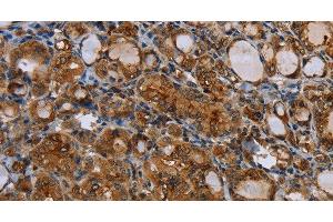 Immunohistochemistry of paraffin-embedded Human thyroid cancer using CD116 Polyclonal Antibody at dilution of 1:35 (CSF2RA 抗体)