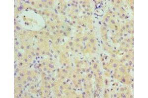 Immunohistochemistry of paraffin-embedded human liver cancer using ABIN7148380 at dilution of 1:100 (Complement Factor B 抗体  (AA 26-751))