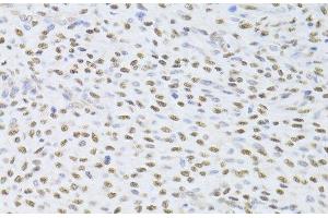 Immunohistochemistry of paraffin-embedded Human adenomyosis using FKBP4 Polyclonal Antibody at dilution of 1:100 (40x lens).