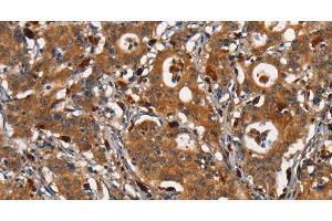 Immunohistochemistry of paraffin-embedded Human gastric cancer tissue using CEACAM3 Polyclonal Antibody at dilution 1:30 (CEACAM3 抗体)