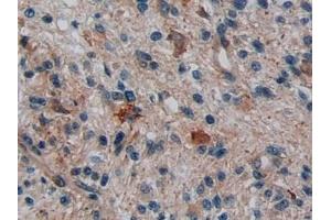 Detection of DISC1 in Human Glioma Tissue using Polyclonal Antibody to Disrupted In Schizophrenia 1 (DISC1)