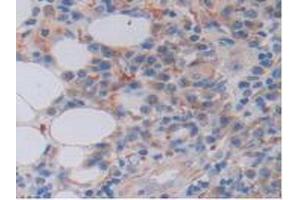 IHC-P analysis of Human Skin Cancer Tissue, with DAB staining. (FKBP7 抗体  (AA 24-217))