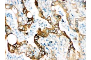 IHC analysis of FASN using anti-FASN antibody (ABIN3044520). (Fatty Acid Synthase 抗体  (AA 1-226))