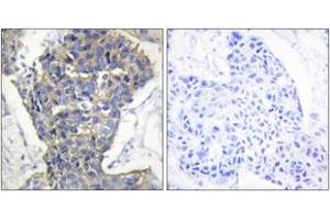Immunohistochemistry analysis of paraffin-embedded human breast carcinoma tissue, using MUNC-18a (Ab-313) Antibody. (STXBP1 抗体  (AA 279-328))