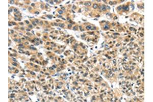 The image on the left is immunohistochemistry of paraffin-embedded Human liver cancer tissue using (TKTL1 Antibody) at dilution 1/40, on the right is treated with fusion protein. (TKTL1 抗体)