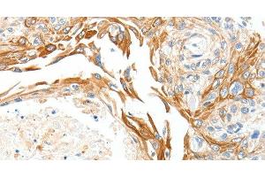Immunohistochemistry of paraffin-embedded Human esophagus cancer using PLAT Polyclonal Antibody at dilution of 1:50 (PLAT 抗体)