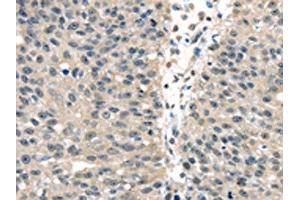 The image on the left is immunohistochemistry of paraffin-embedded Human breast cancer tissue using ABIN7128063(UCHL3 Antibody) at dilution 1/25, on the right is treated with fusion protein. (UCHL3 抗体)