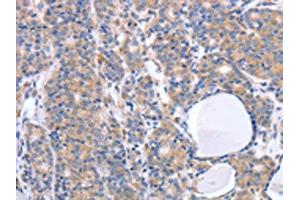 The image on the left is immunohistochemistry of paraffin-embedded Human thyroid cancer tissue using ABIN7190789(GFRA4 Antibody) at dilution 1/40, on the right is treated with synthetic peptide. (GFRA4 抗体)