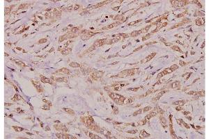 Immunohistochemistry analysis of Connexin-32 antibody in paraffin-embedded human breast carcinoma tissue at 1/100 dilution. (GJB1 抗体)