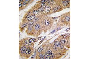 Formalin-fixed and paraffin-embedded human breast carcinoma tissue reacted with RPS6KB1 Antibody  g , which was peroxidase-conjugated to the secondary antibody, followed by DAB staining.