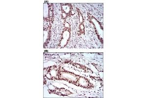 Immunohistochemical staining of cervical cancer tissues (A) and colon cancer tissues (B) with KHDRBS2 monoclonal antibody, clone 7G8C10  at 1:200-1:1000 dilution. (KHDRBS2 抗体  (AA 160-349))