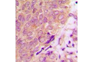 Immunohistochemical analysis of Caspase 6 staining in human prostate cancer formalin fixed paraffin embedded tissue section. (Caspase 6 抗体  (C-Term))