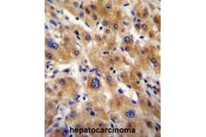 AHSG antibody (C-term) immunohistochemistry analysis in formalin fixed and paraffin embedded human hepatocarcinoma followed by peroxidase conjugation of the secondary antibody and DAB staining.
