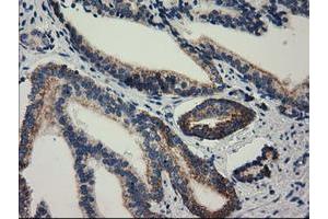 Immunohistochemical staining of paraffin-embedded Carcinoma of Human prostate tissue using anti-RASD2 mouse monoclonal antibody. (RASD2 抗体)