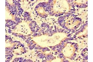 Immunohistochemistry of paraffin-embedded human colon cancer using ABIN7143463 at dilution of 1:100 (GGA1 抗体  (AA 1-89))