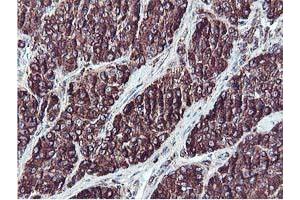 Immunohistochemical staining of paraffin-embedded Carcinoma of Human liver tissue using anti-ILVBL mouse monoclonal antibody. (ILVBL 抗体)