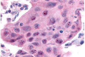 Anti-ESRRA antibody  ABIN1048580 IHC staining of human breast carcinoma. (ESRRA 抗体  (Internal Region))