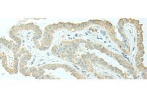 Immunohistochemistry of paraffin-embedded Human thyroid cancer tissue using EVI2B Polyclonal Antibody at dilution of 1:40(x200) (EVI2B 抗体)