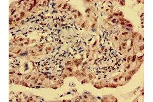 Immunohistochemistry analysis of human lung cancer using ABIN7142618 at dilution of 1:100 (Serotonin Receptor 1E 抗体  (AA 203-291))