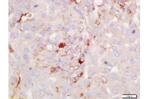 Formalin-fixed and paraffin embedded human lung carcinoma labeled with Anti-RGS2 Polyclonal Antibody, Unconjugated (ABIN669291) at 1:200 followed by conjugation to the secondary antibody and DAB staining. (RGS2 抗体  (AA 116-211))