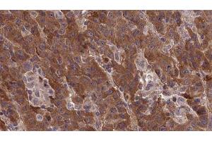 ABIN6277377 at 1/100 staining Human liver cancer tissue by IHC-P. (Metabotropic Glutamate Receptor 1 抗体  (Internal Region))