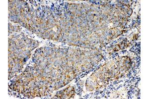 TECTA was detected in paraffin-embedded sections of human lung cancer tissues using rabbit anti- TECTA Antigen Affinity purified polyclonal antibody (Catalog # ) at 1 µg/mL. (TECTA 抗体  (N-Term))