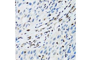 Immunohistochemistry of paraffin-embedded human lung cancer using FLI1 antibody (ABIN1876845) at dilution of 1:100 (40x lens). (FLI1 抗体)
