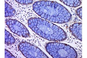Paraformaldehyde-fixed, paraffin embedded human colon cancer, Antigen retrieval by boiling in sodium citrate buffer (pH6. (C12orf42 抗体)