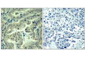 Immunohistochemical analysis of paraffin-embedded human lung carcinoma tissue using eIF4G(Phospho-Ser1232) Antibody(left) or the same antibody preincubated with blocking peptide(right). (EIF4G1 抗体  (pSer1232))