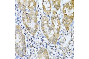 Immunohistochemistry of paraffin-embedded human gastric cancer using ASIP antibody at dilution of 1:100 (40x lens). (ASIP 抗体)