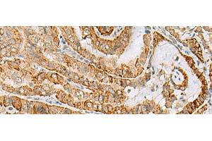 Immunohistochemistry of paraffin-embedded Human thyroid cancer tissue using FARP2 Polyclonal Antibody at dilution of 1:70(x200) (FARP2 抗体)