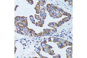 Immunohistochemistry of paraffin-embedded human gastric cancer using GIP antibody (ABIN5973668) at dilution of 1/100 (40x lens). (GIP 抗体)
