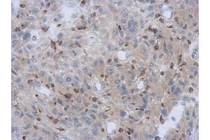 IHC-P Image Immunohistochemical analysis of paraffin-embedded U373 xenograft, using NDUFV1, antibody at 1:500 dilution. (NDUFV1 抗体  (Center))