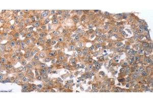 Immunohistochemistry of paraffin-embedded Human breast cancer using NQO2 Polyclonal Antibody at dilution of 1:50 (NQO2 抗体)