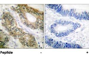 Immunohistochemical analysis of paraffin-embedded human colon carcinoma tissue using ESPL1 polyclonal antibody . (Separase 抗体)