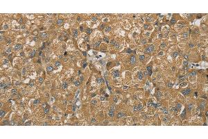 Immunohistochemistry of paraffin-embedded Human liver cancer using SDHB Polyclonal Antibody at dilution of 1:30 (SDHB 抗体)